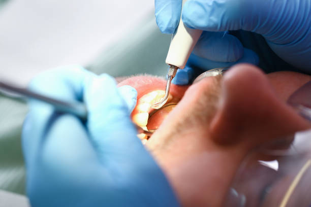 Best Emergency Tooth Extraction in Marshfield, WI